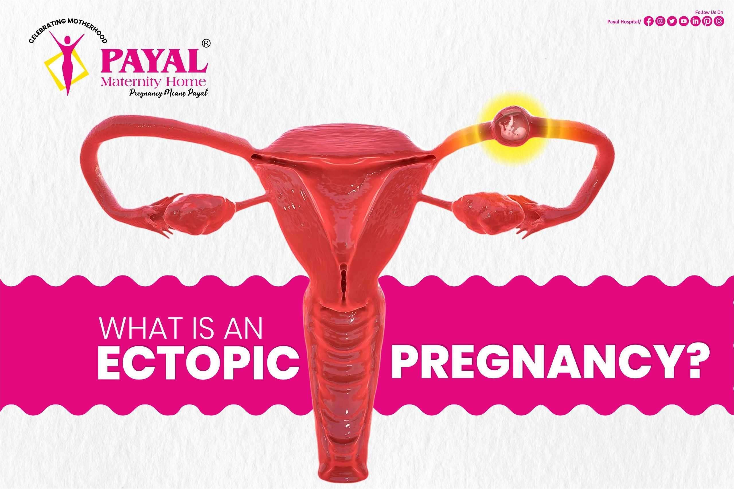 Ectopic Pregnancy