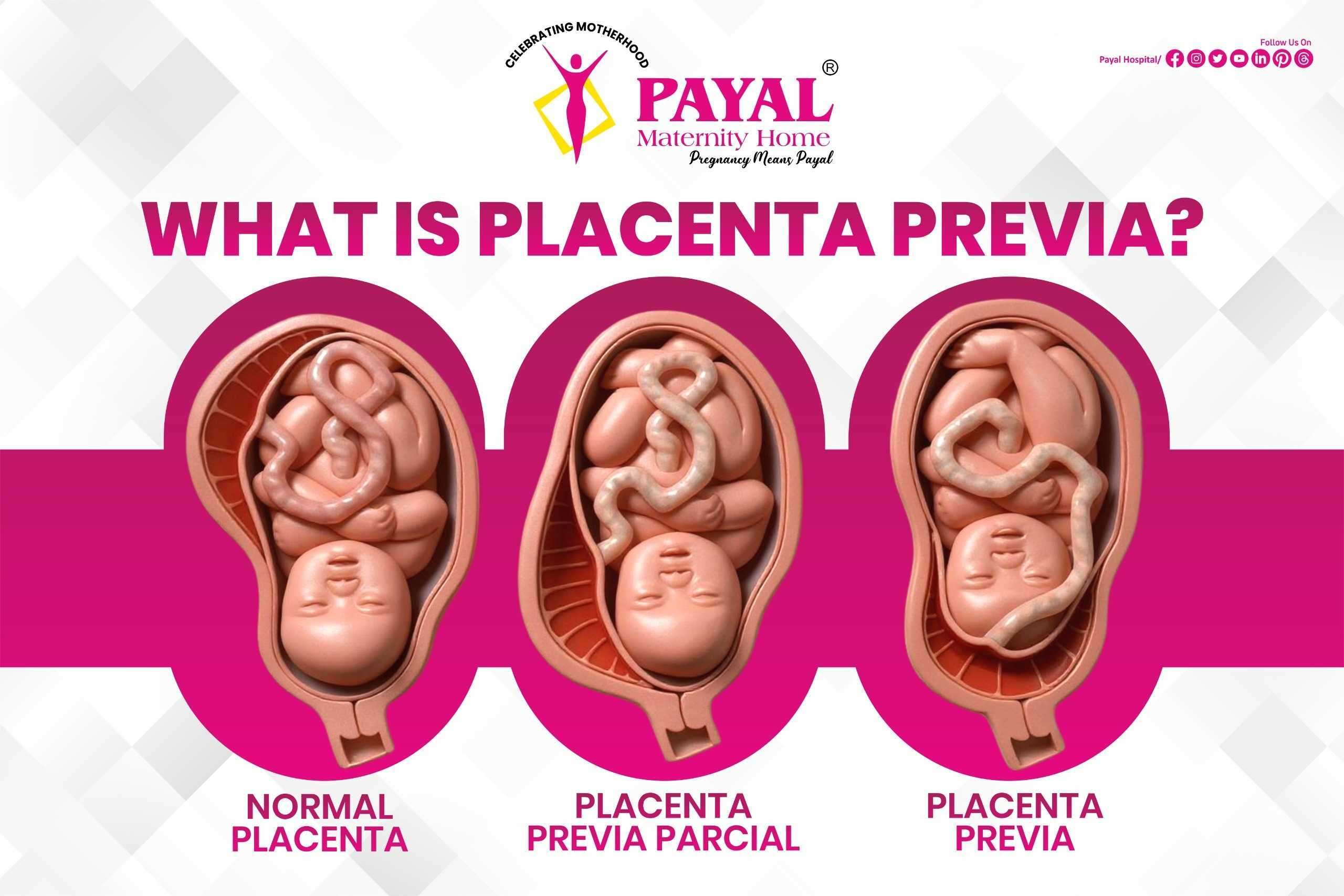 What is Placenta Previa?