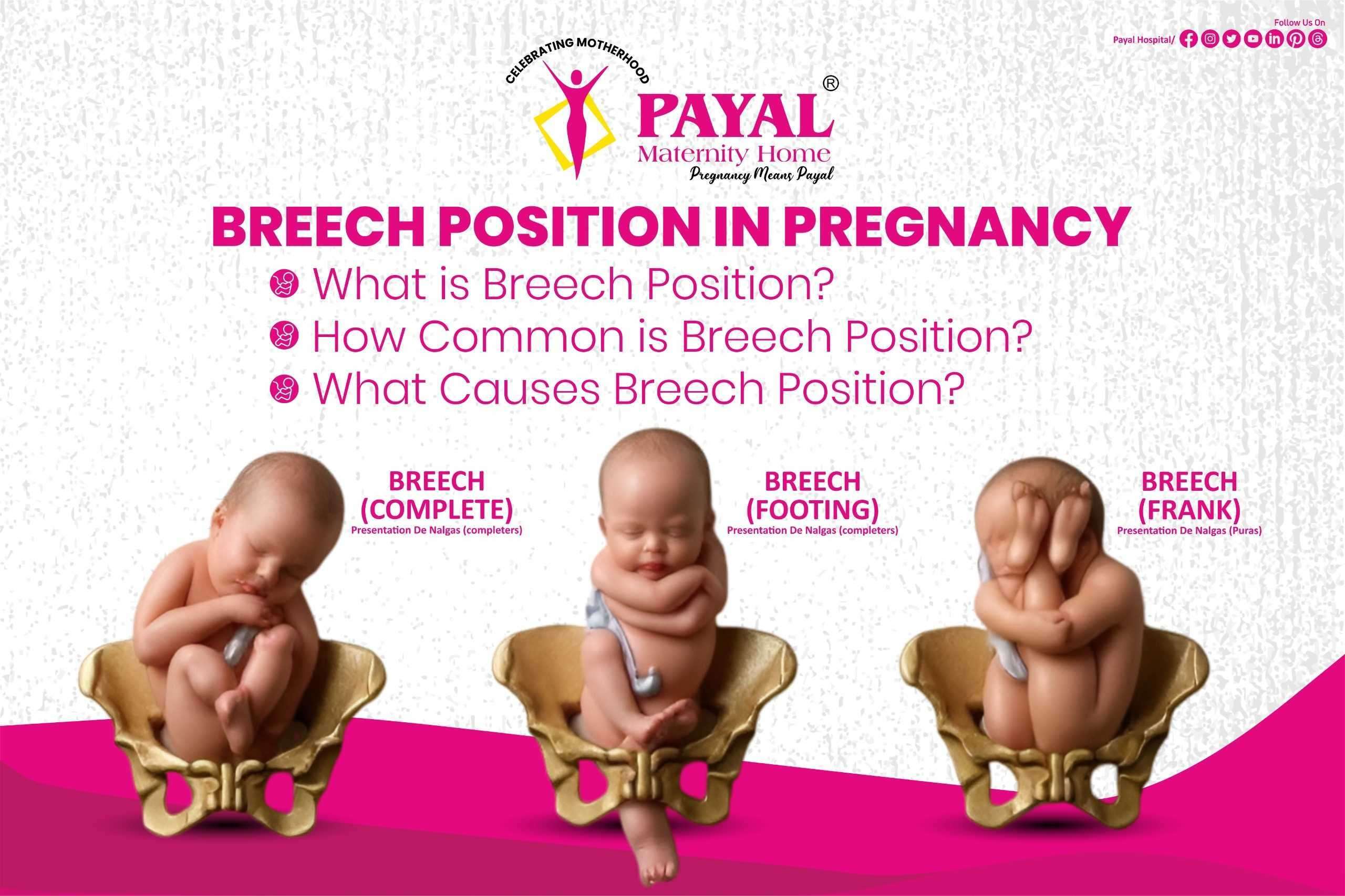 Breech Position in Pregnancy